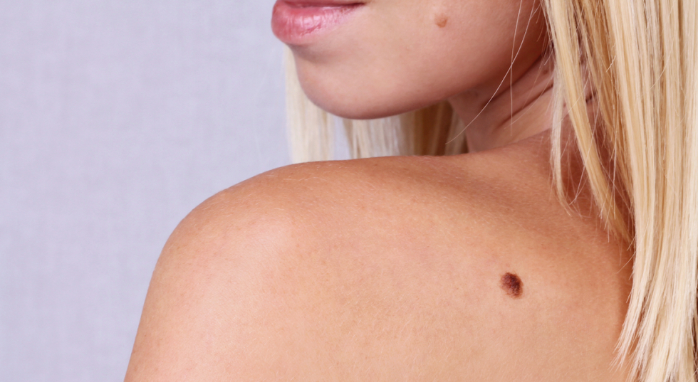 Dermatologija - mladeži i njihovo uklanjanje